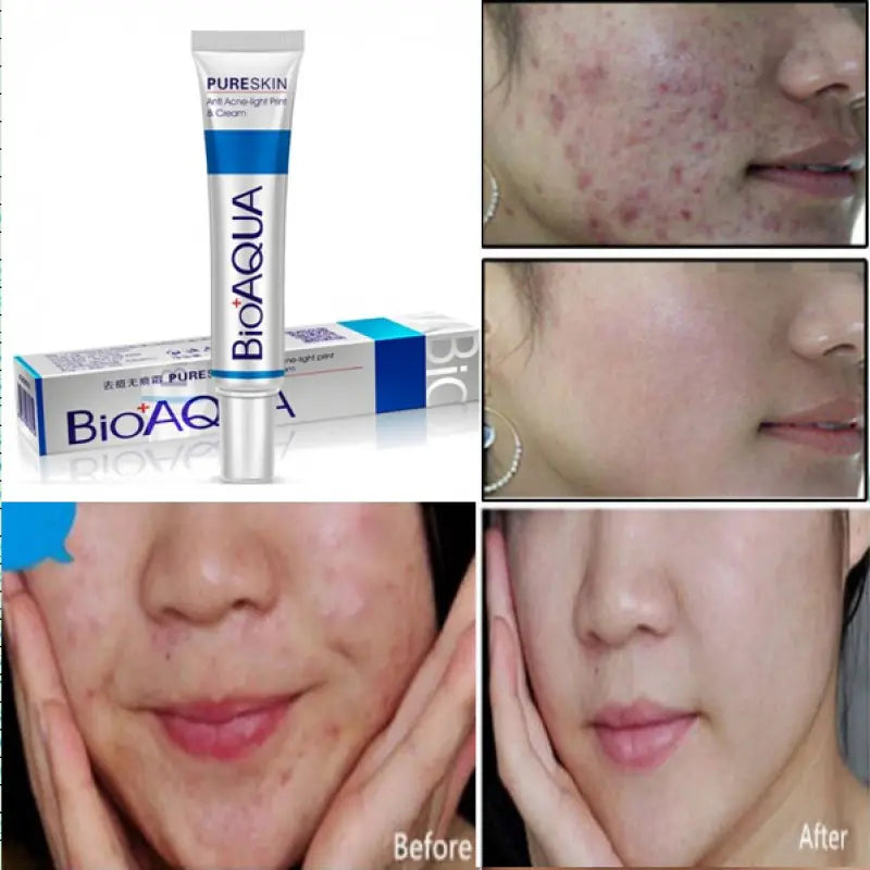 Bio Aqua Acne Removal Cream - Oshi.pk - Buy & Sell Online