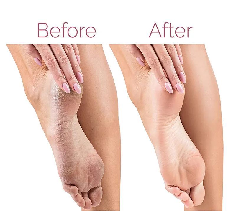 Electric Foot File For Heels Grinding Pedicure Tools Callus Remover USB Rechargeable Professional Foot Care Tool Dead Hard Skin - Oshi.pk - Buy & Sell Online
