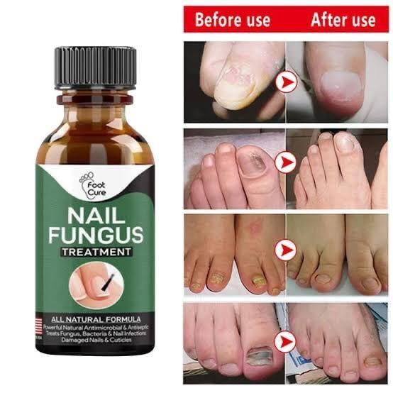 Nail Fungus Treatment Stop Fungal Growth Effective Fingernail 10ml - Oshi.pk - Buy & Sell Online