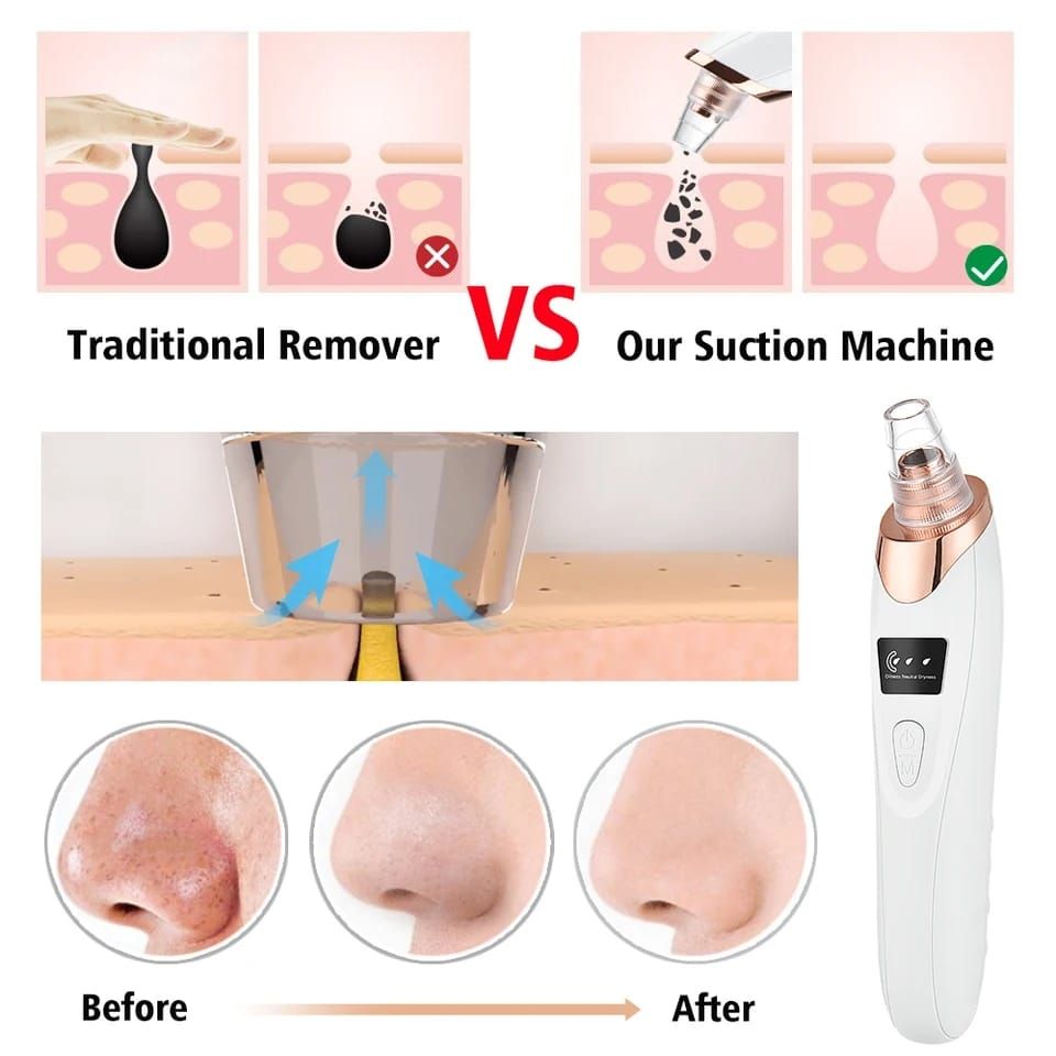 Rechargeable 5-in-1 Blackhead and Acne Removal Vacuum: Unleash Your Skin's Radiance with Our Ultimate Facial Beauty Solution! - Oshi.pk - Buy & Sell Online