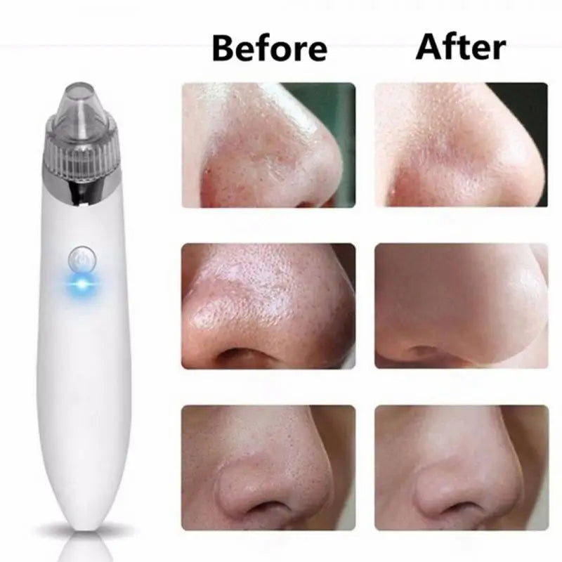 Rechargeable Electric Suck Blackhead Removal, Dead Skin Acne Remove & Skin Pore Cleaner - Oshi.pk - Buy & Sell Online