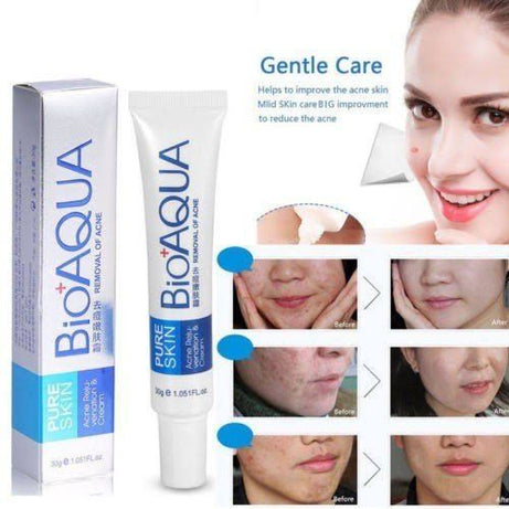 Bio Aqua Acne Cream Face Skin Care Acne Anti-Wrinkle Removal Cream Spots Scar Blemish Marks 30g