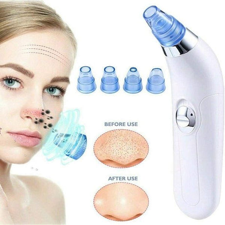 Electric Blackhead Acne Oil Remover Vacuum Suction Face Pore Cleaner - Oshi.pk - Buy & Sell Online