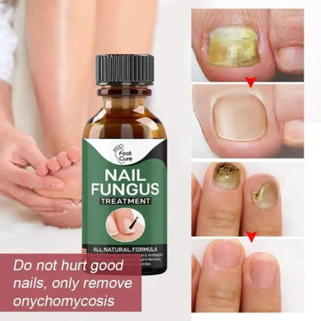 Fast Nail Fungal Treatments Nail Repair Essences Serum Care Treatments Foot Nail Fungus Removal Gel Paronychia Onychomycosis - Oshi.pk - Buy & Sell Online