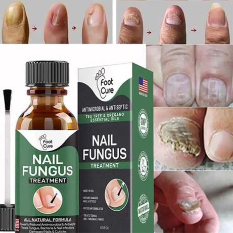Nail Fungus Treatment Stop Fungal Growth Effective Fingernail 10ml - Oshi.pk - Buy & Sell Online