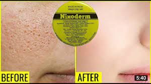 Nixoderm cream For Skin Problem (20G) - Oshi.pk - Buy & Sell Online