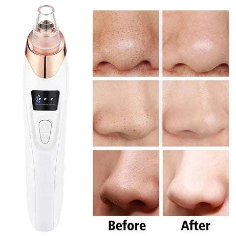 Upgraded Blackhead Remover Vacuum Facial Pore Cleaner Electric Acne Comedone Whitehead Extractor Tool 5 Probes For Women And Men - Oshi.pk - Buy & Sell Online